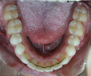 Marie-Hélène Cyr - Vue occlusale inférieure - Après des traitements d'orthodontie et des chirurgies orthognatiques (29 janvier 2010)